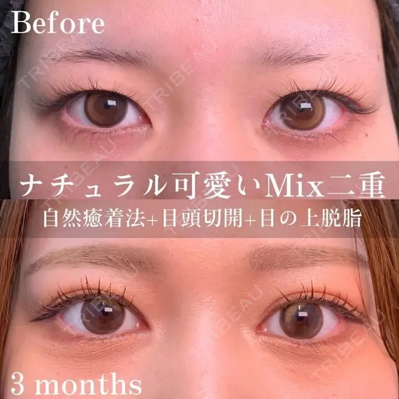自然癒着法＋目頭切開＋目の上脱脂 before画像 メイン用
