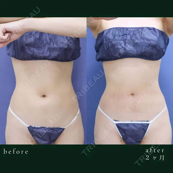 しっかり薄くなり、くびれも綺麗に出来ています✨ before画像 メイン用