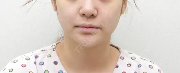 二重あご脂肪吸引 before画像 メイン用