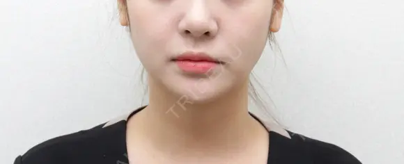 二重あご脂肪吸引 after画像 メイン用
