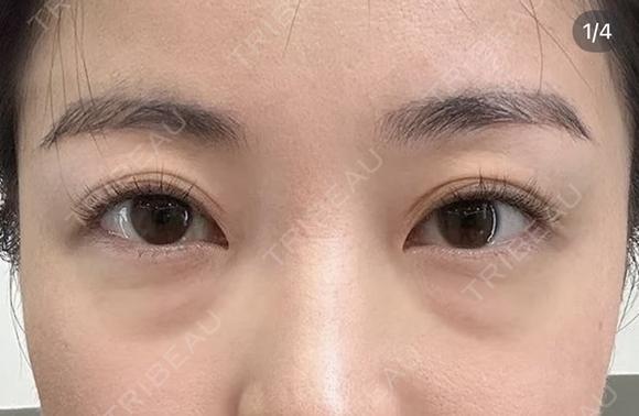 医療ハイフ　300ショット目周り before画像 メイン用