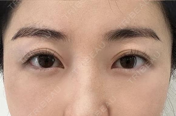 医療ハイフ　300ショット目周り after画像 メイン用