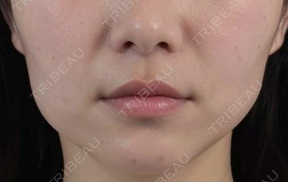 医療ハイフ　部分300ショット before画像 メイン用