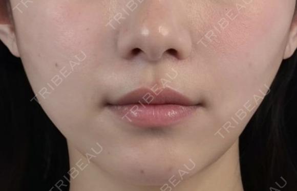 医療ハイフ　部分300ショット after画像 メイン用