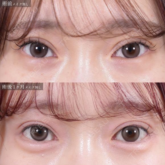 切らない眼瞼下垂＋目尻切開＋タレ目切開（皮膚） 60日後 メイン用