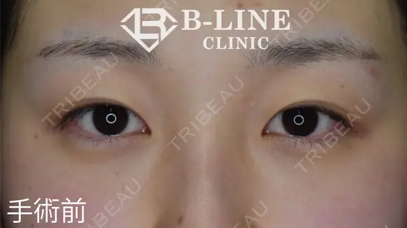 【切開法二重術】1ヵ月後 before画像 メイン用