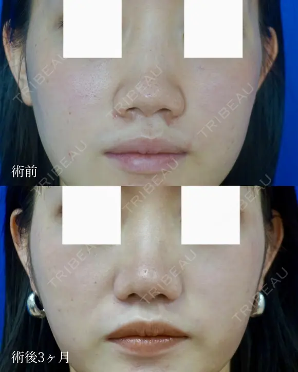 鼻尖縮小＋鼻翼縮小（外側法） after画像 メイン用