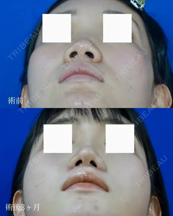 鼻尖縮小＋鼻翼縮小（外側法） after画像 メイン用