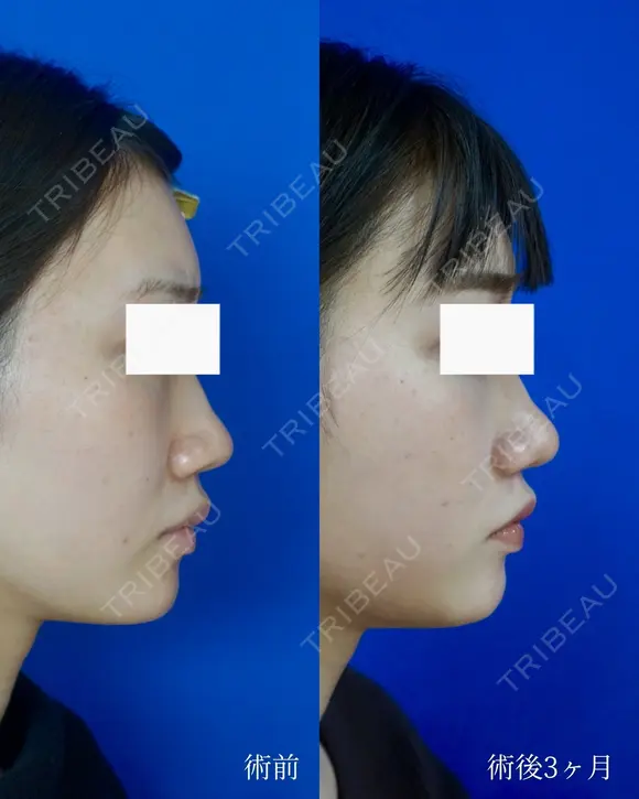 鼻尖縮小＋鼻翼縮小（外側法） after画像 メイン用