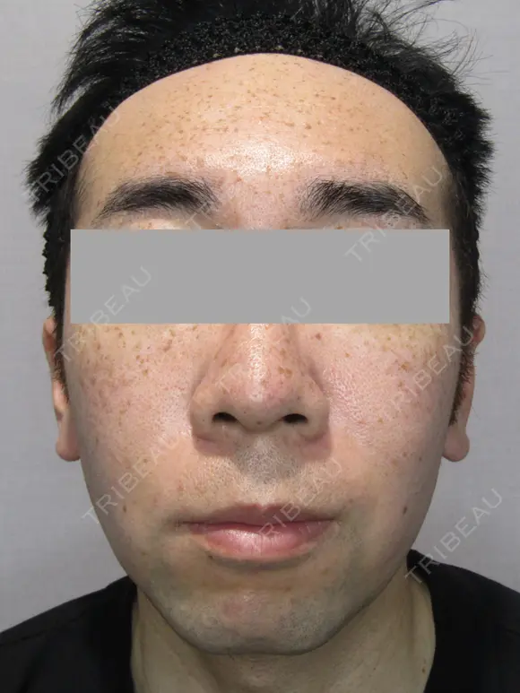 IPL治療(アキュライト・アキュプラス) before画像 メイン用