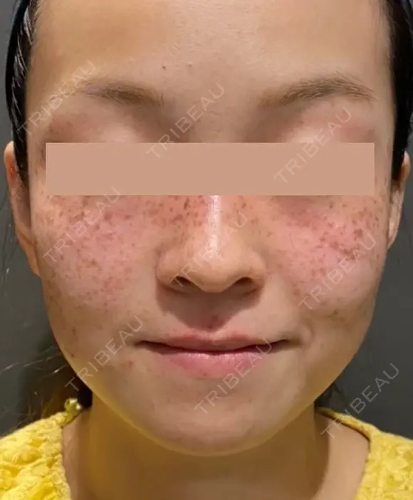 IPL治療(アキュライト・アキュプラス) before画像 メイン用