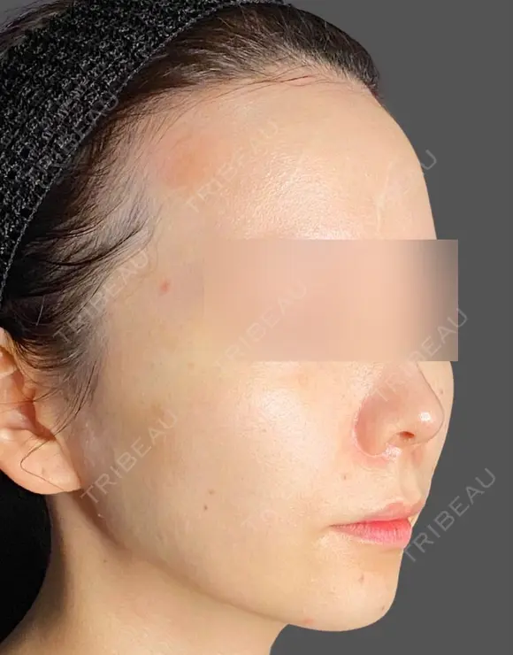唇のヒアルロン酸注入 before画像 メイン用