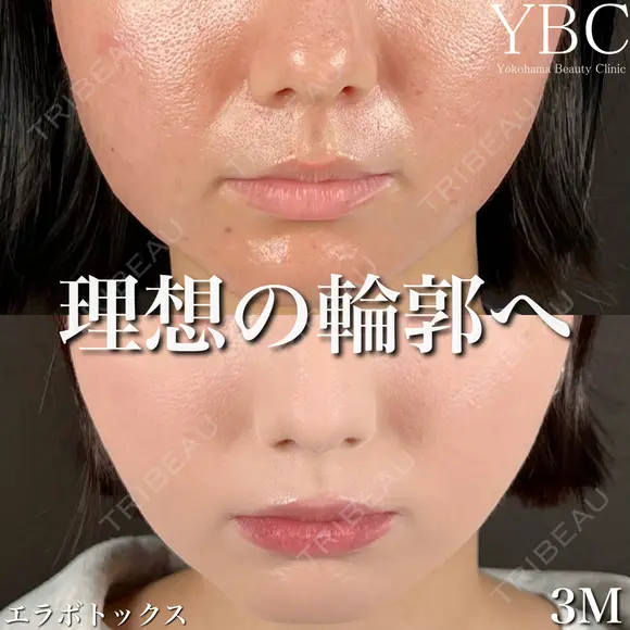 【🍫エラボトックス🍫】 before画像 メイン用