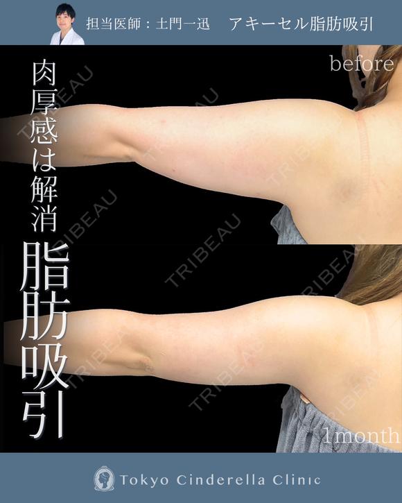 アキーセル脂肪吸引(二の腕全周) before画像 メイン用