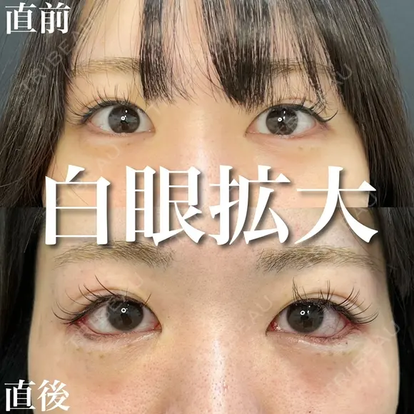 白目拡大（目尻切開＋タレ目形成） before画像 メイン用