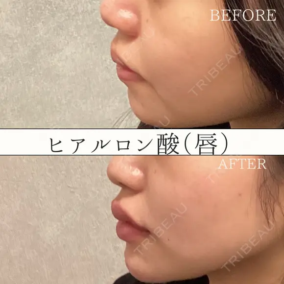 唇ヒアルロン酸 注入術 after画像 メイン用