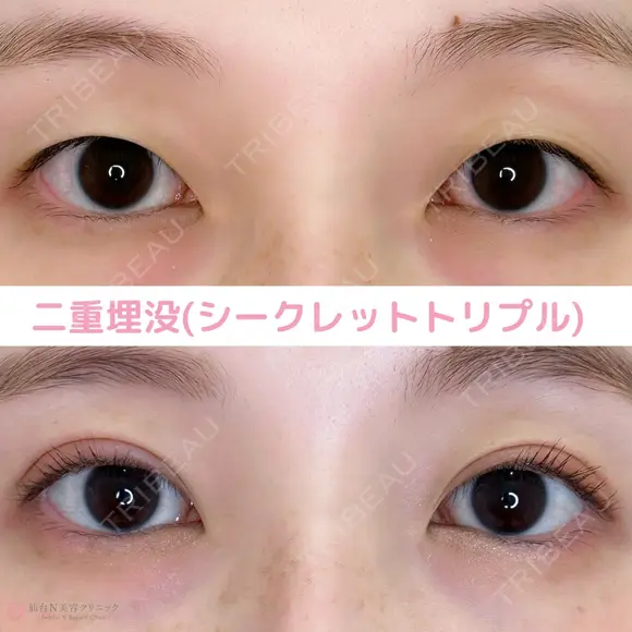 二重埋没 after画像 メイン用