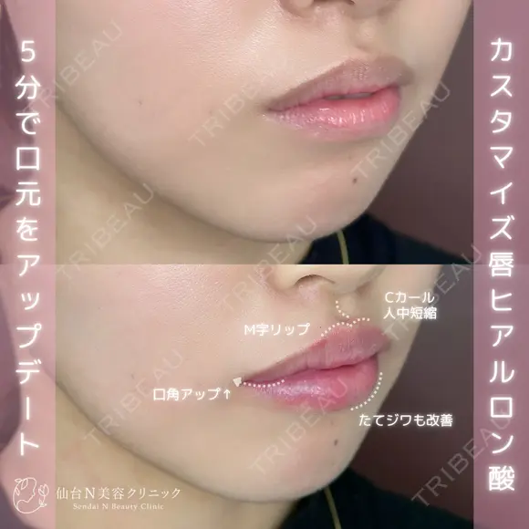ヒアルロン酸 after画像 メイン用