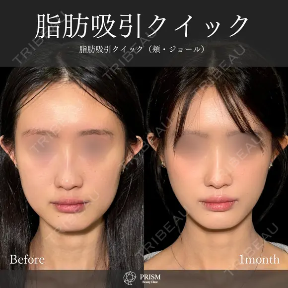 💙🦖【脂肪吸引注射】で綺麗なフェイスラインに🦖💙 before画像 メイン用