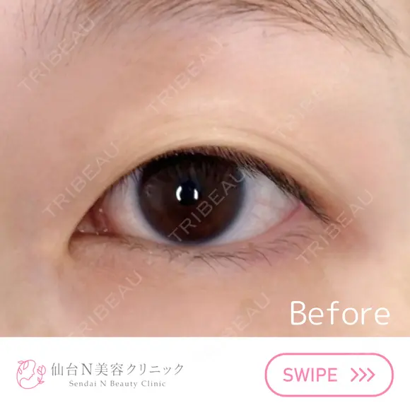 二重埋没 before画像 メイン用