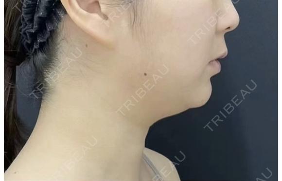 医療ハイフ　輪郭 before画像 メイン用