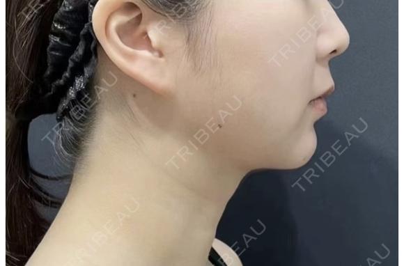 医療ハイフ　輪郭 after画像 メイン用