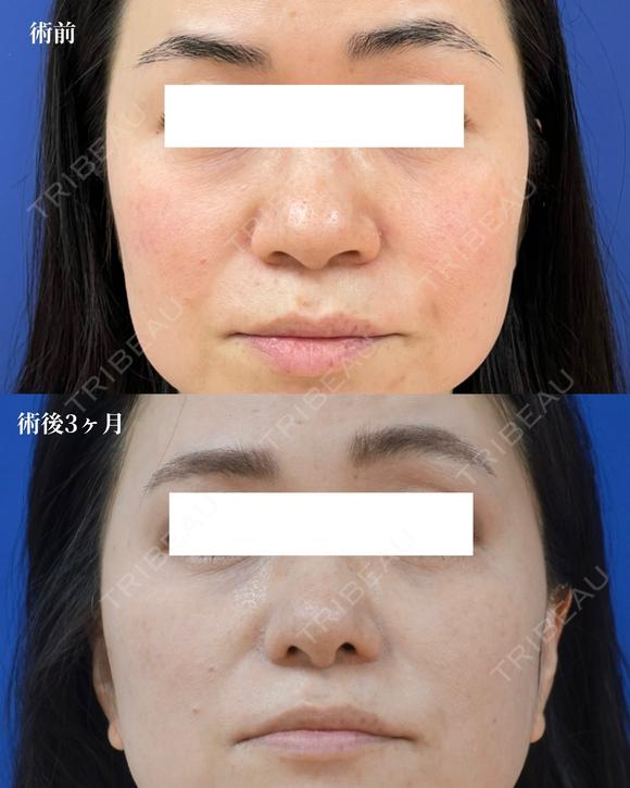 鼻尖縮小＋鼻翼縮小(外側法) after画像 メイン用