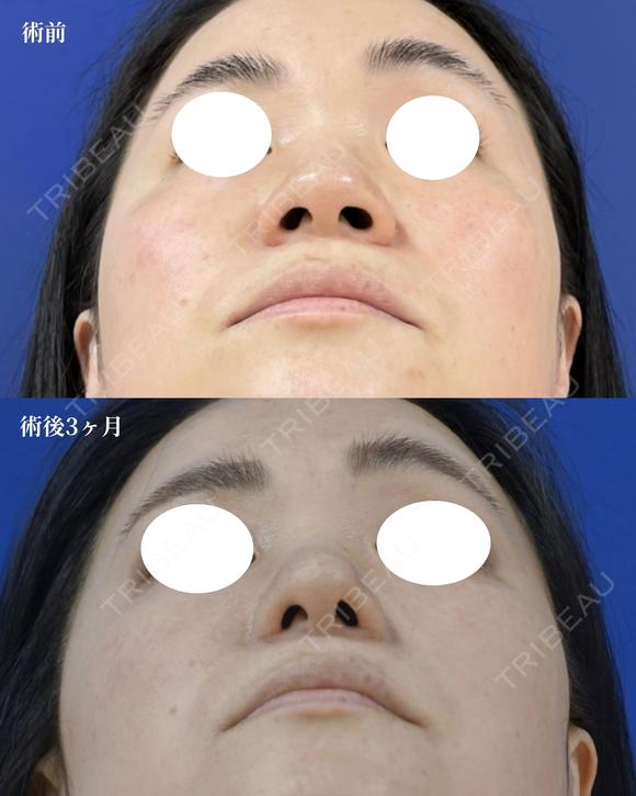 鼻尖縮小＋鼻翼縮小(外側法) after画像 メイン用