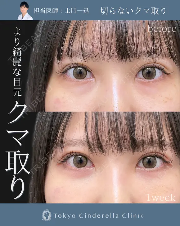 切らないクマ取り 7日後 メイン用