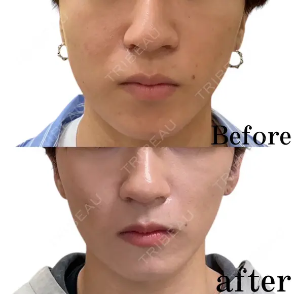 エラボトックス after画像 メイン用