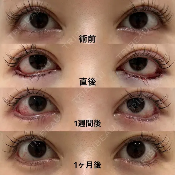 たれ目形成、滑らかなS字デザイン after画像 メイン用