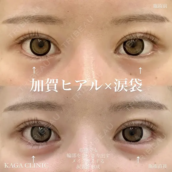 加賀ヒアル×涙袋 before画像 メイン用