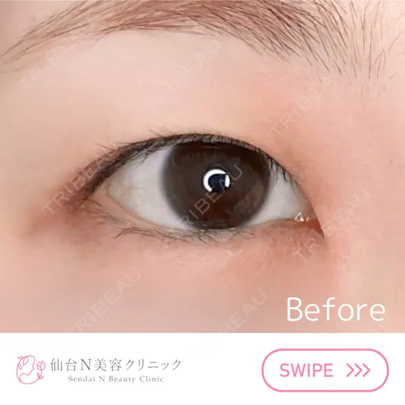 二重埋没 before画像 メイン用