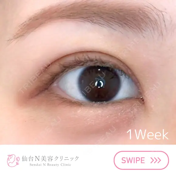 二重埋没 7日後 メイン用