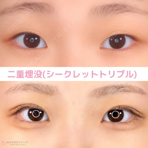 二重埋没 after画像 メイン用