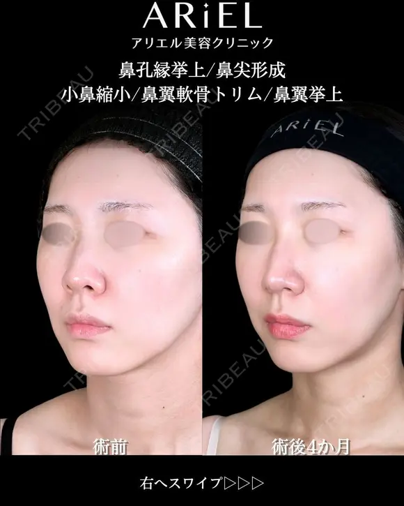 鼻孔縁挙上/鼻尖形成/ 小鼻縮小/鼻翼軟骨トリム/鼻翼挙上 before画像 メイン用
