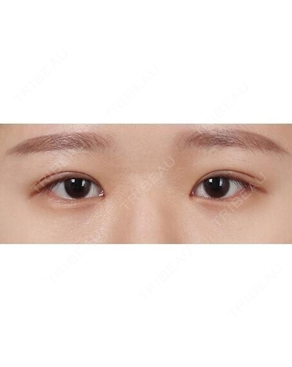 目つき矯正｜二重切開＋眼瞼下垂｜まぶたが厚く目の開きを良くしたい方に 1日後 メイン用