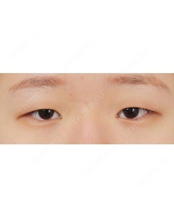 目つき矯正｜二重切開＋眼瞼下垂｜まぶたが厚く目の開きを良くしたい方に before画像 メイン用