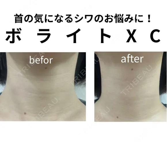 アラガン社製ボライトXC before画像 メイン用