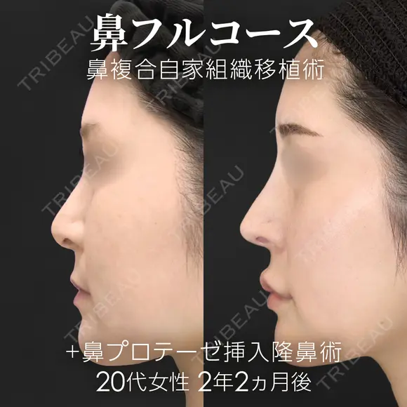 鼻フルコース（鼻複合自家組織移植術）＋鼻プロテーゼ挿入隆鼻術 before画像 メイン用