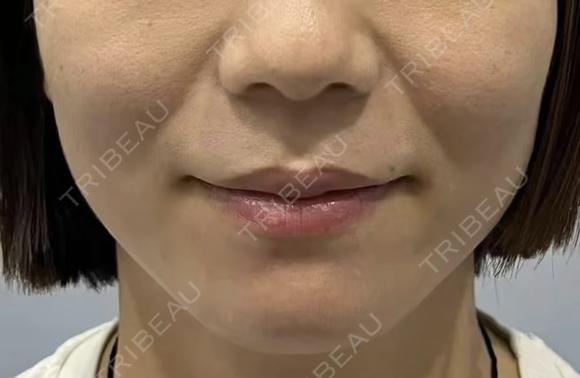 医療ハイフほうれい線 before画像 メイン用