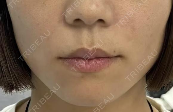 医療ハイフほうれい線 after画像 メイン用