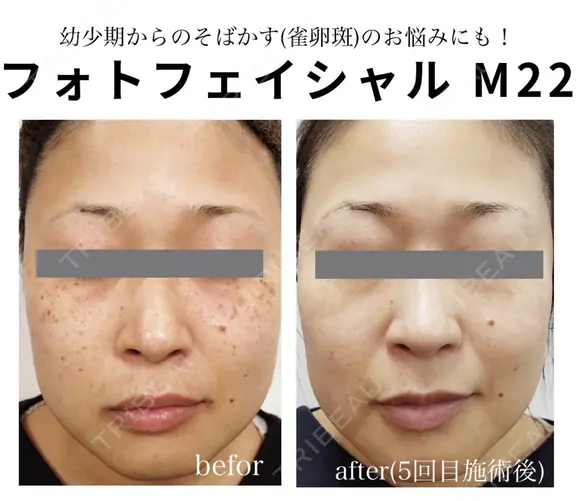 フォトフェイシャル M22（IPL） before画像 メイン用