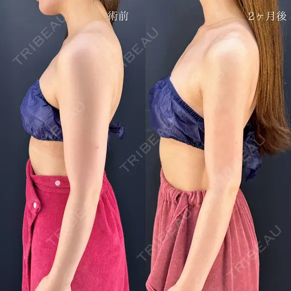 二の腕脂肪吸引 before画像 メイン用
