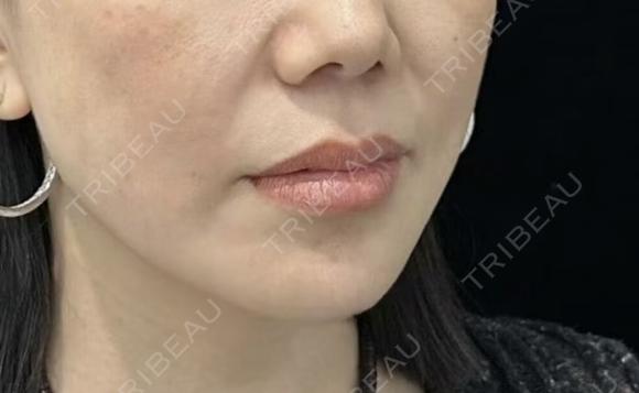 医療ハイフ　600ショット before画像 メイン用