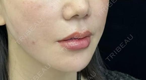 医療ハイフ　600ショット after画像 メイン用