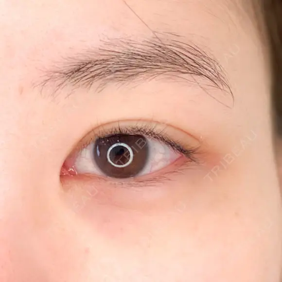 目尻が下がってモテ女子に♪パーフェクトアイズの処置前と処置後2週間の症例です【パーフェクトアイズ】 before画像 メイン用