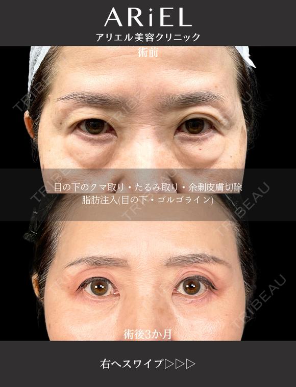 切らない目の下のクマとり・余剰皮膚切除・脂肪注入目の下/ゴルゴライン before画像 メイン用