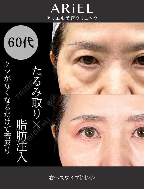 切らない目の下のクマとり・余剰皮膚切除・脂肪注入目の下/ゴルゴライン 90日後 メイン用
