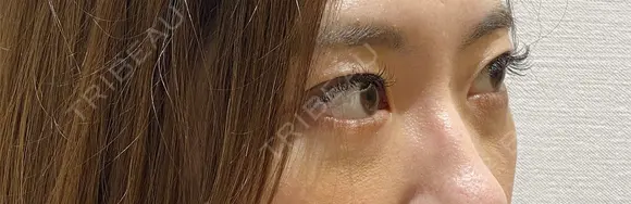 目の下の脂肪取り 6日後 メイン用